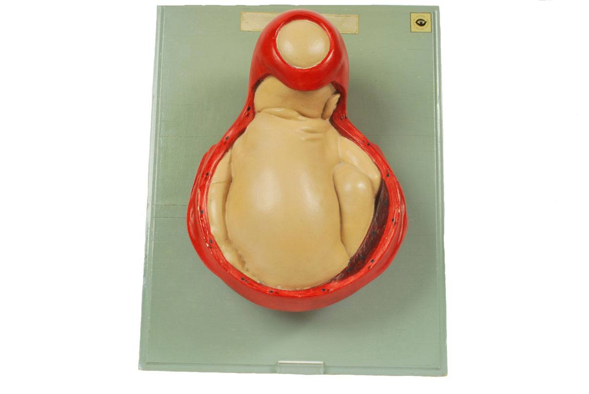 Old medical instruments/4075-Borning baby